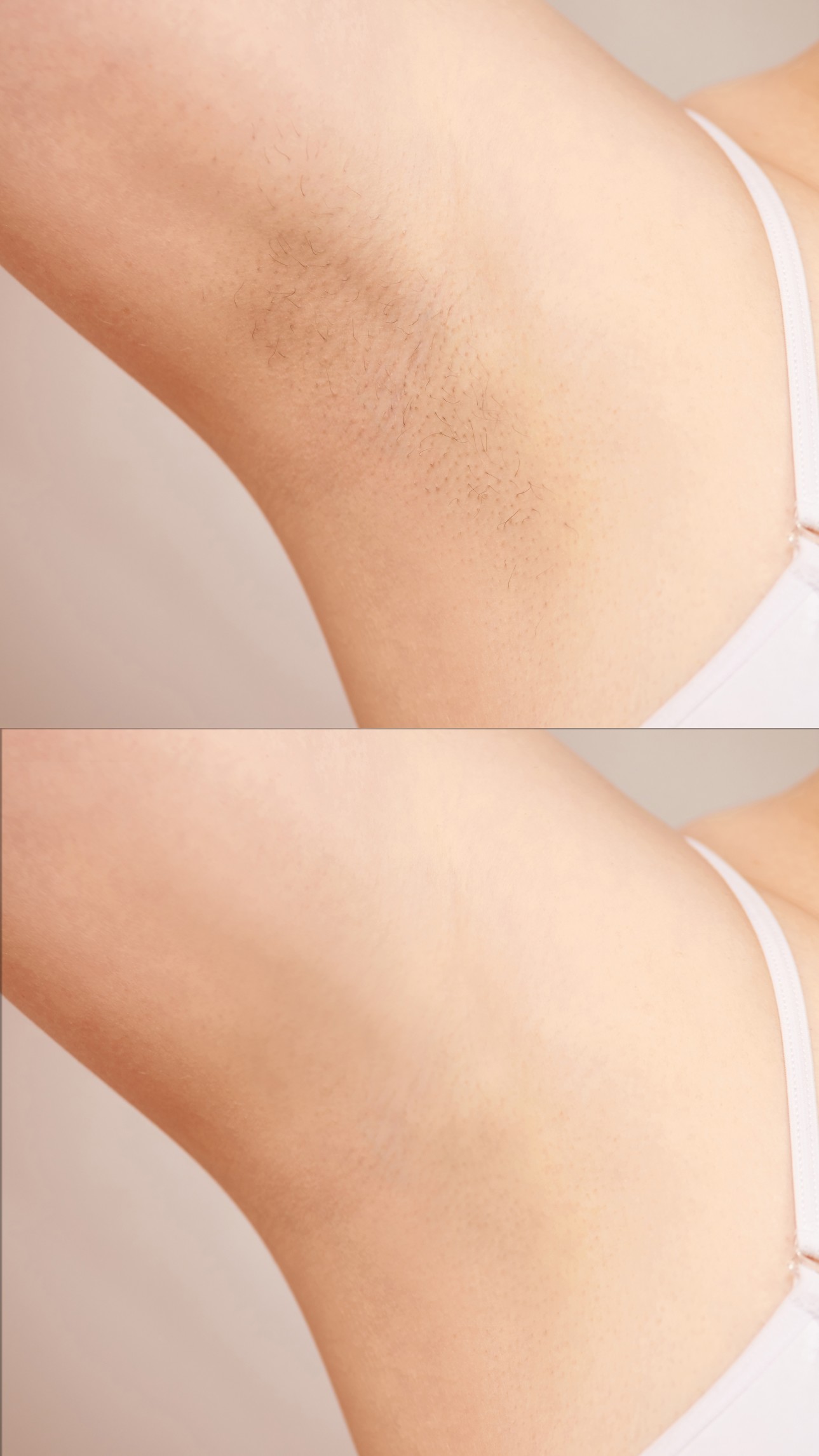 Is Laser Hair Removal Safe?