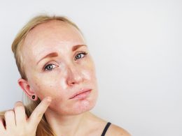 How to Get Rid of Pigmentation on Face Easily
