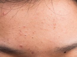 How to Get Rid of Closed Comedones