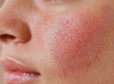 face redness